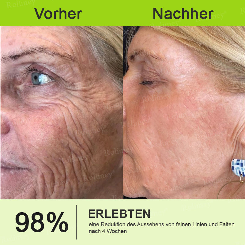 🌿👨‍⚕️Jetzt jugendliche Haut zurückgewinnen 💫Rolimey® Botox & Vita-A Retinol Shot Falten-Lift Straffungscreme