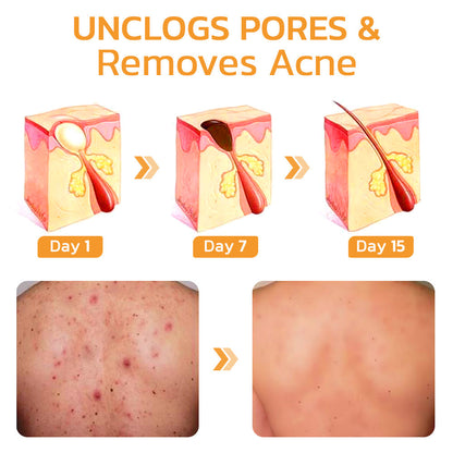 🧡GFOUK™ FAFASKIN Rückenflecken und Akanthose Nigricans Reinigungslotion-Letzter Tag: 50 % Rabatt