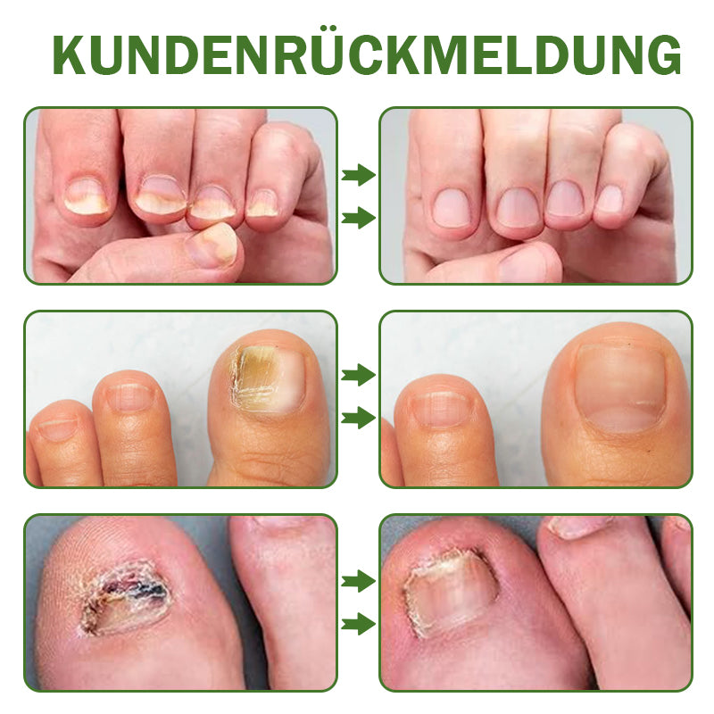 🐝Furzero™ Nagelverteidigung Bienengift-Behandlungsserum pro