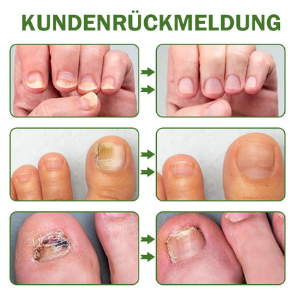🐝Furzero™ Nagelverteidigung Bienengift-Behandlungsserum pro