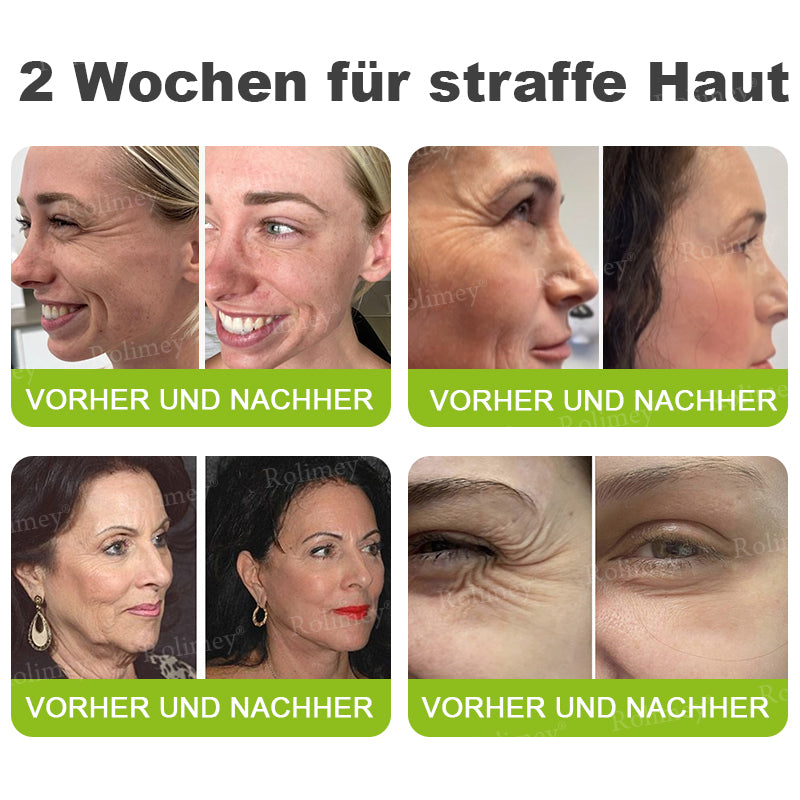 🌿👨‍⚕️Jetzt jugendliche Haut zurückgewinnen 💫Rolimey® Botox & Vita-A Retinol Shot Falten-Lift Straffungscreme