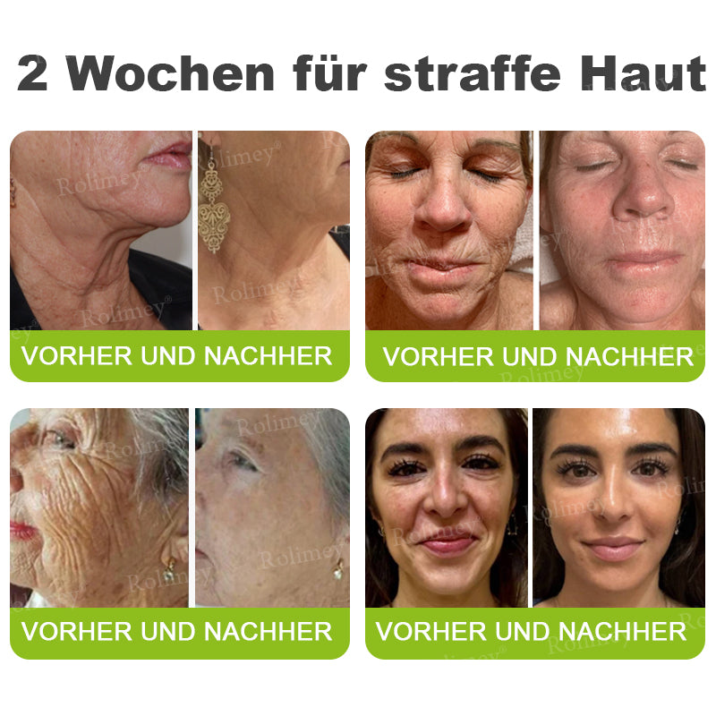 🌿👨‍⚕️Jetzt jugendliche Haut zurückgewinnen 💫Rolimey® Botox & Vita-A Retinol Shot Falten-Lift Straffungscreme